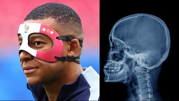 Kylian Mbappé sufrió fractura del tabique en el partido de Austria vs Francia por la Eurocopa 2024. (Foto: AFP)